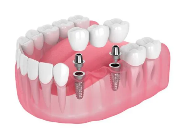 Titan implant